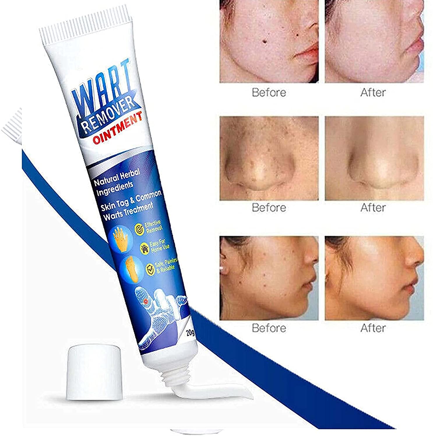 Wart Remover Ointment